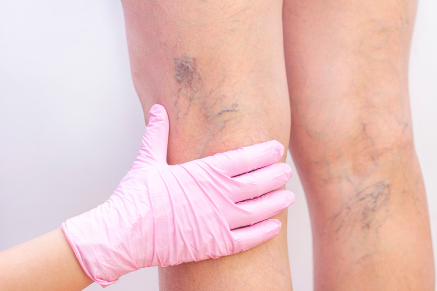 Varicose veins: causes and treatment methods